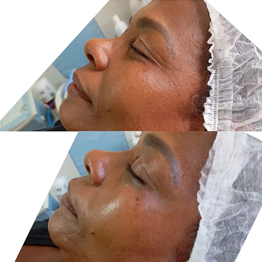Radiofrequência Facial - Antes e Depois