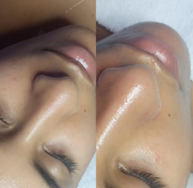 Peeling Químico - Antes e Depois