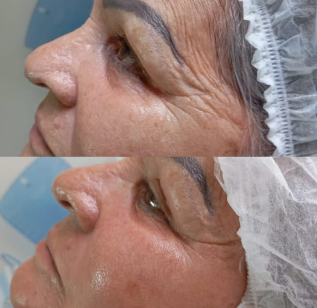 Clareamento de Manchas - Antes e Depois