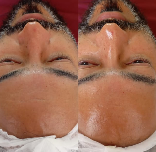 Microagulhamento com PDRN - Antes e Depois